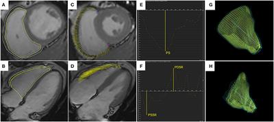 Regional Fat Distributions Are Associated With Subclinical Right Ventricular Dysfunction in Adults With Uncomplicated Obesity